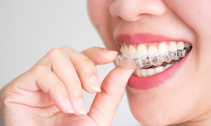 How Invisalign Can Straighten Your Smile Without Braces (1)