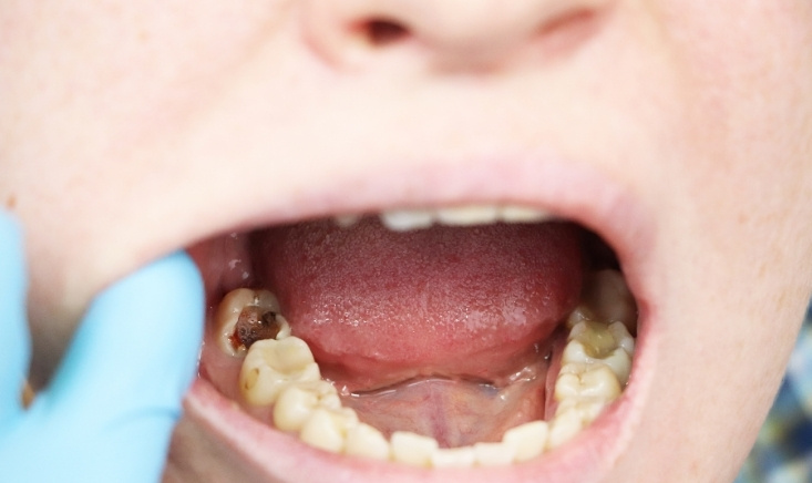 find and treat a cavity between two teeth