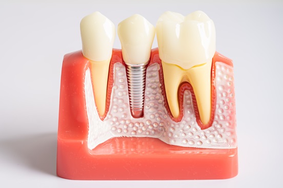 Top Reasons Patients Are Switching to Dental Implants
