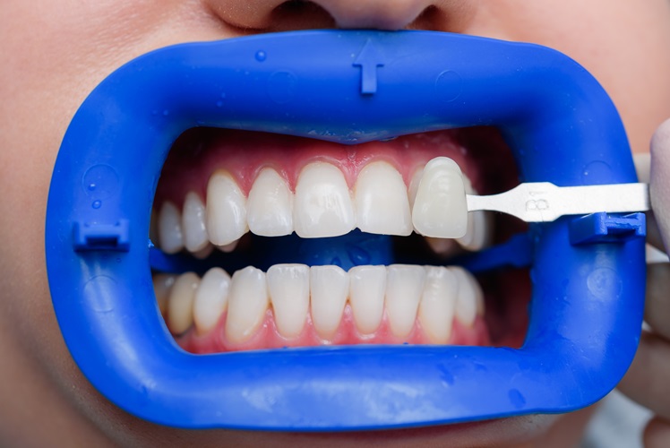 Top Benefits of Getting Dental Veneers